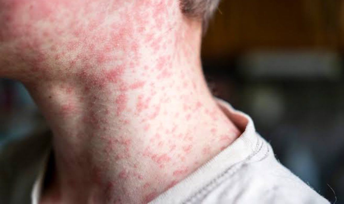 Alerta de sarampión para viajeros