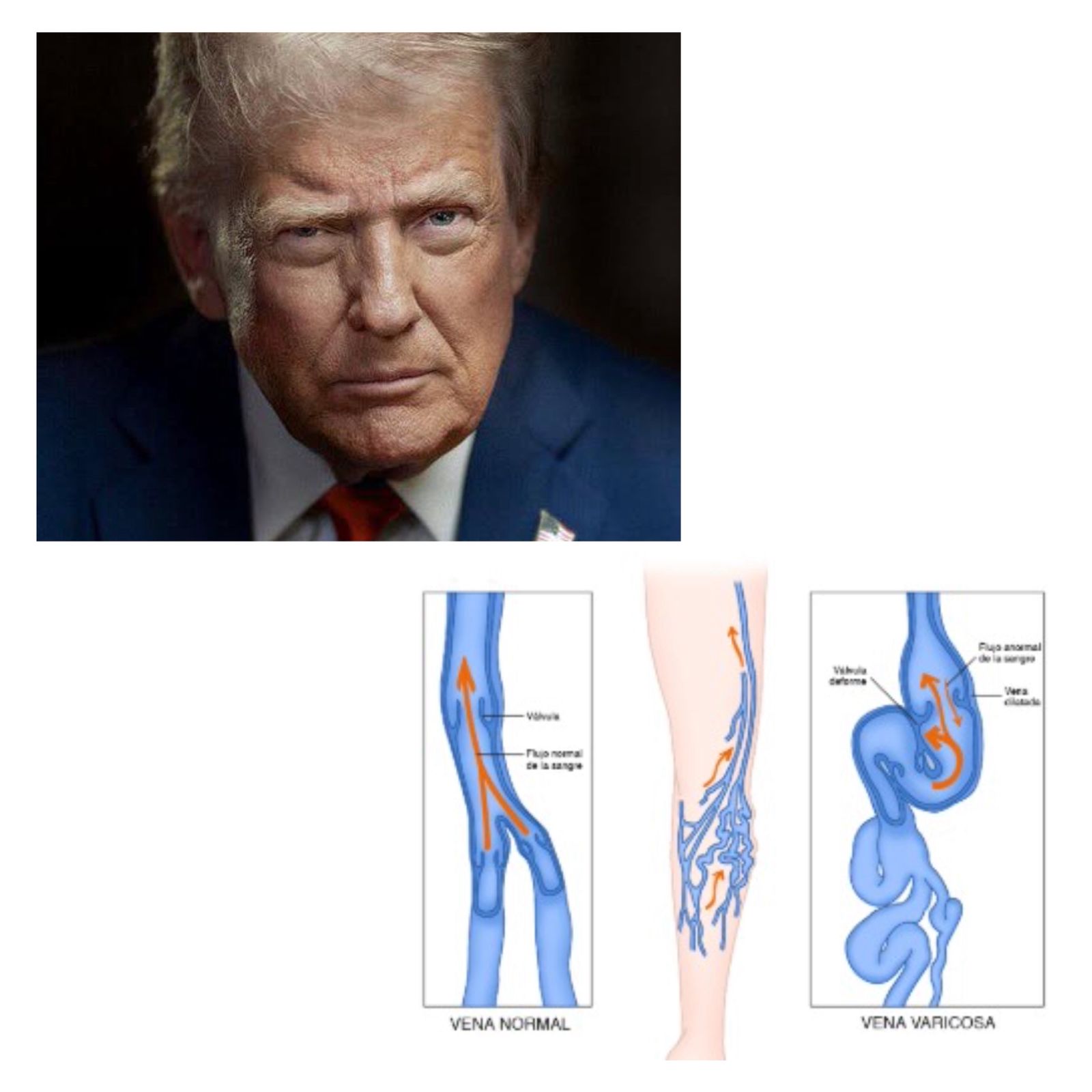 Donald Trump diagnosticado con insuficiencia venosa crónica
