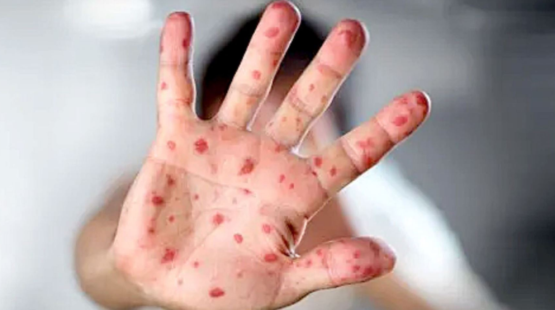 Mpox ha reaparecido en Yucatán tras cuatro meses sin casos, con cuatro confirmados en 2025, posicionando al estado entre los 15 con mayor incidencia en México